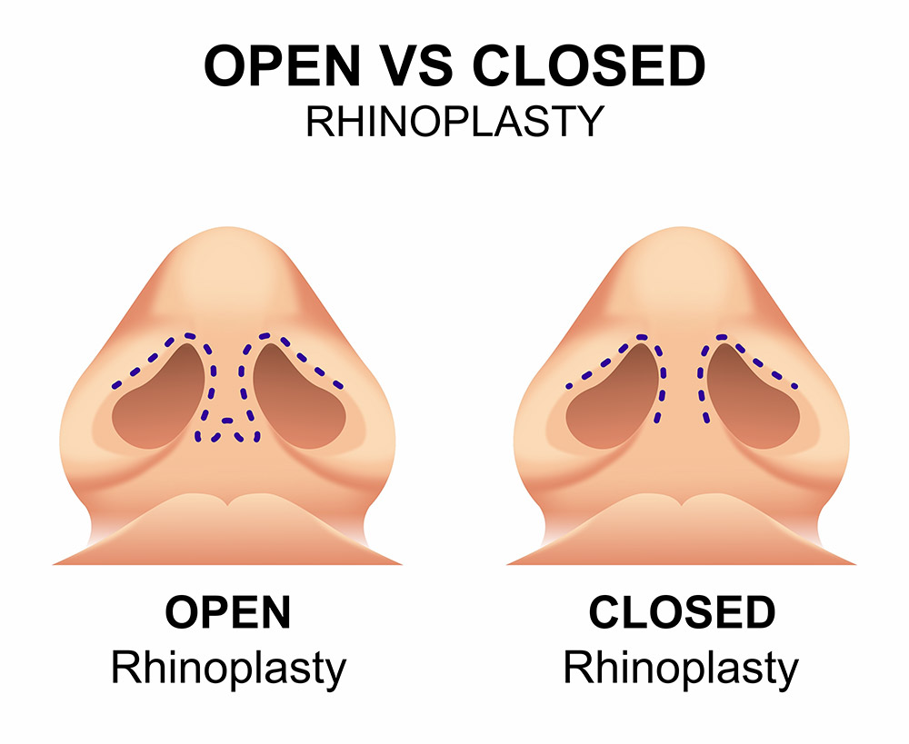 open vs closed rhinoplasty, rhinoplasty incisions, nasal framework
