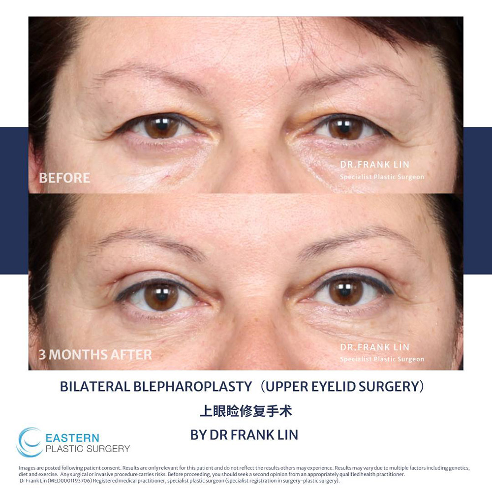 brow lift vs blepharoplasty, upper eyelid surgery, brow position
